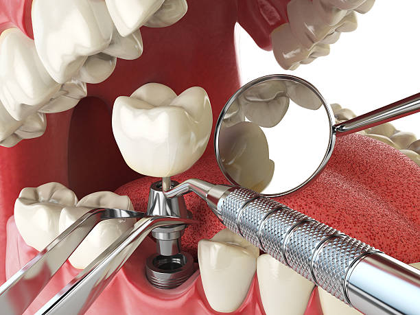 Best Root Canal Emergency Dentist  in Willow Park, TX